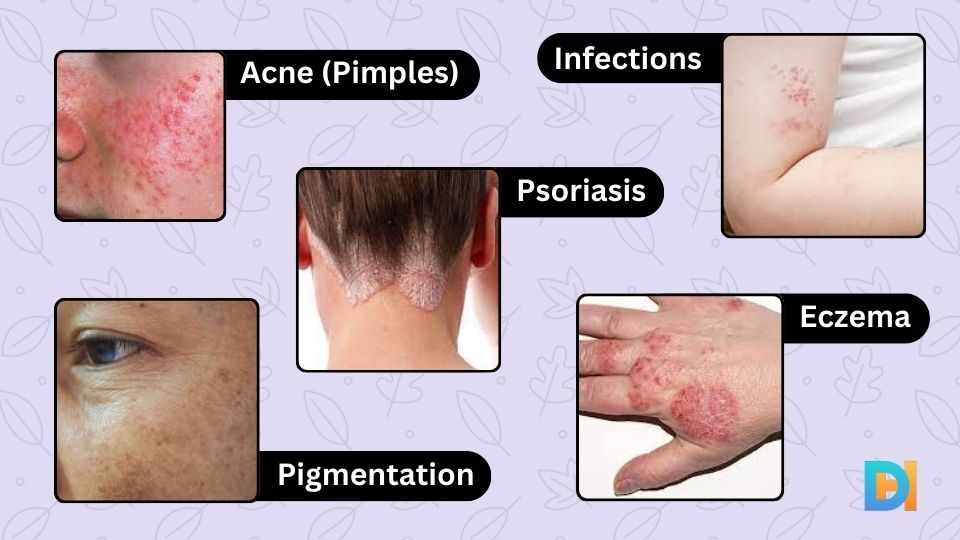 Skin Problems Acne Pimples infections Durgapur Hub